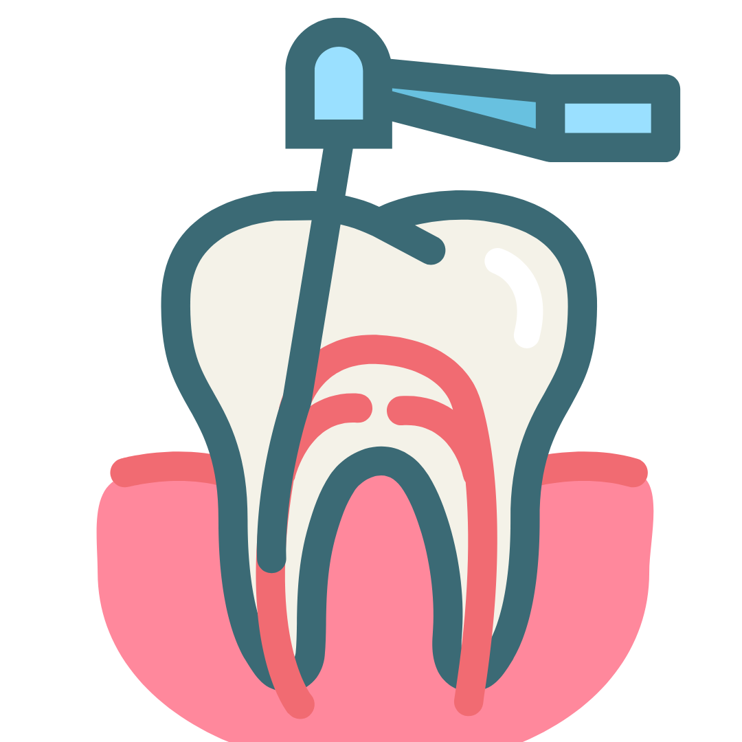 Single Sitting Root Canal Treatment